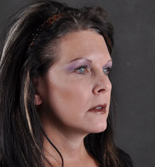 facelift - patient 8850 - after 2 facelift - patient 8850 - after 2