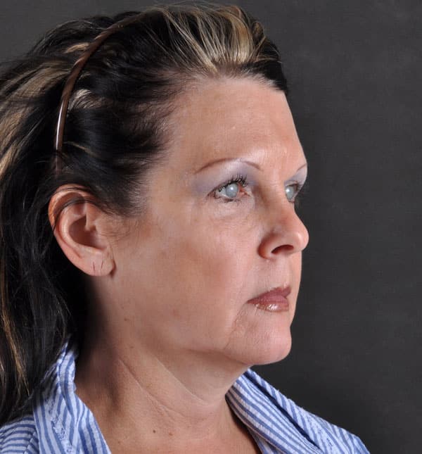 facelift - patient 8850 - before 2 facelift - patient 8850 - before 2