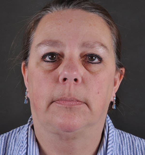 facelift - patient 8995 - after 1 facelift - patient 8995 - after 1