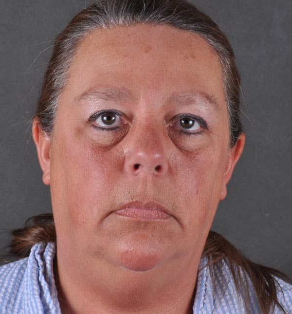 facelift - patient 8995 - before 1 facelift - patient 8995 - before 1