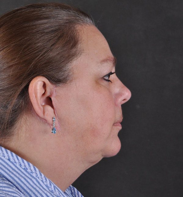 facelift - patient 8995 - after 3 facelift - patient 8995 - after 3