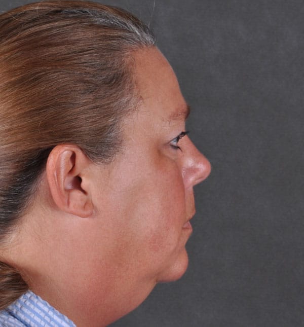 facelift - patient 8995 - before 3 facelift - patient 8995 - before 3