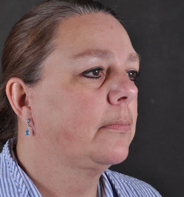 facelift - patient 8995 - after 2 facelift - patient 8995 - after 2