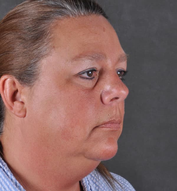 facelift - patient 8995 - before 2 facelift - patient 8995 - before 2