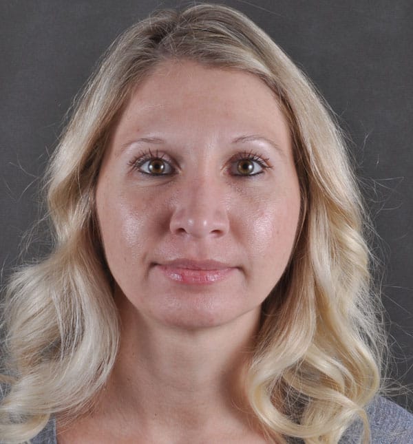 rhinoplasty - patient 8609 - after 1 rhinoplasty - patient 8609 - after 1