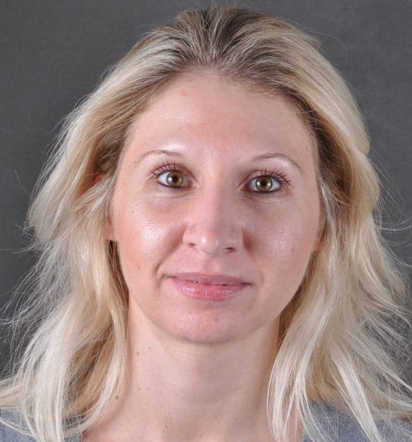 rhinoplasty - patient 8609 - before 1 rhinoplasty - patient 8609 - before 1