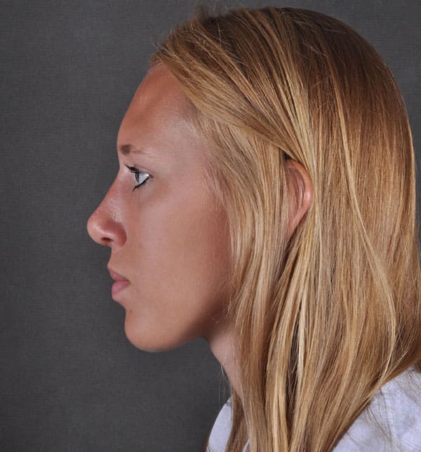 rhinoplasty - patient 8843 - after 3 rhinoplasty - patient 8843 - after 3