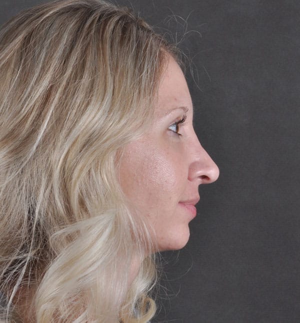 rhinoplasty - patient 8609 - after 2 rhinoplasty - patient 8609 - after 2