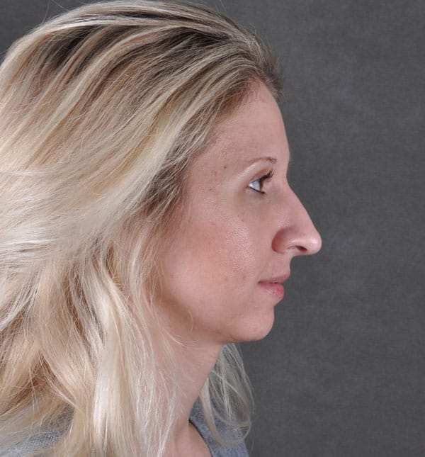 rhinoplasty - patient 8609 - before 2 rhinoplasty - patient 8609 - before 2