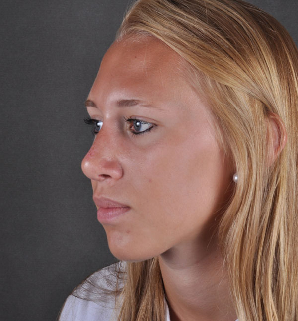 rhinoplasty - patient 8843 - after 2 rhinoplasty - patient 8843 - after 2