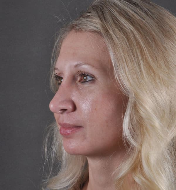 rhinoplasty - patient 8609 - after 3 rhinoplasty - patient 8609 - after 3