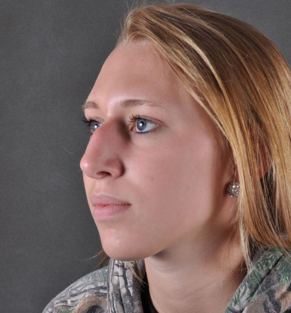 rhinoplasty - patient 8843 - before 2 rhinoplasty - patient 8843 - before 2