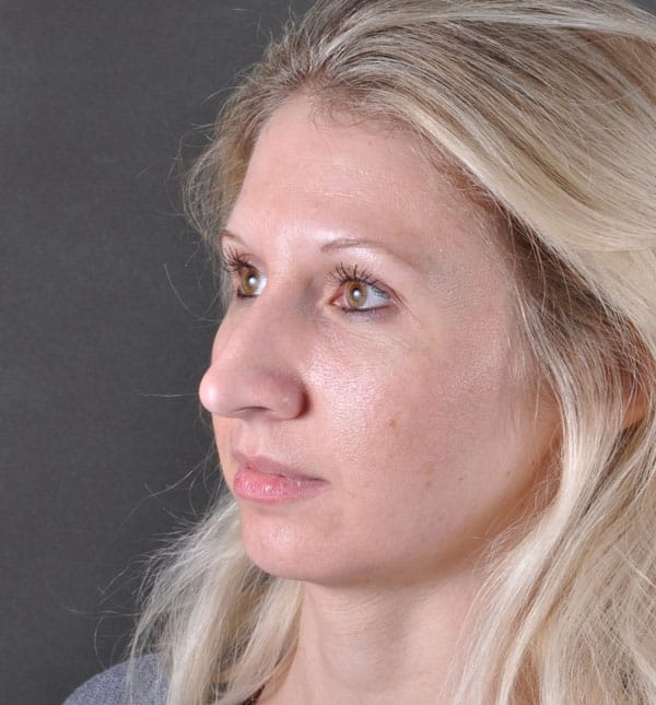 rhinoplasty - patient 8609 - before 3 rhinoplasty - patient 8609 - before 3