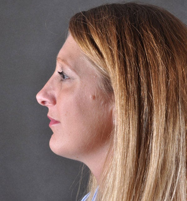 rhinoplasty - patient 9150 - after 5 rhinoplasty - patient 9150 - after 5