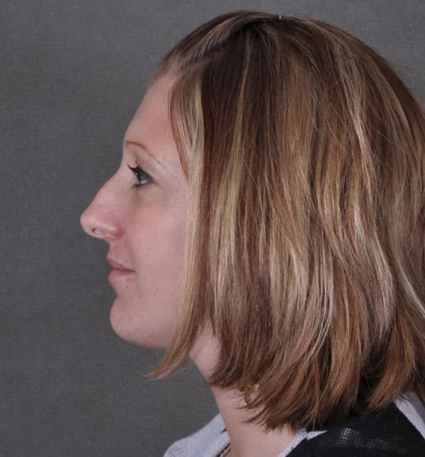 rhinoplasty - patient 9150 - before 5 rhinoplasty - patient 9150 - before 5
