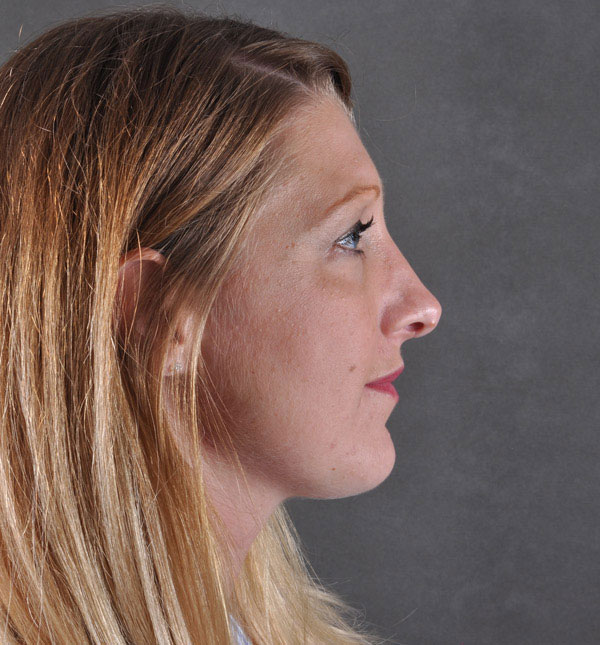 rhinoplasty - patient 9150 - after 3 rhinoplasty - patient 9150 - after 3