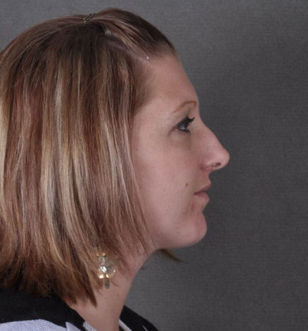 rhinoplasty - patient 9150 - before 3 rhinoplasty - patient 9150 - before 3