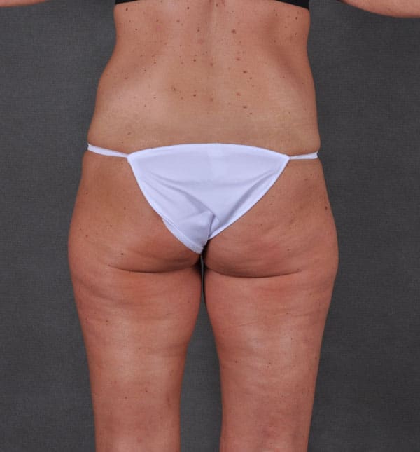 liposuction - patient 8682 - before 4 liposuction - patient 8682 - before 4