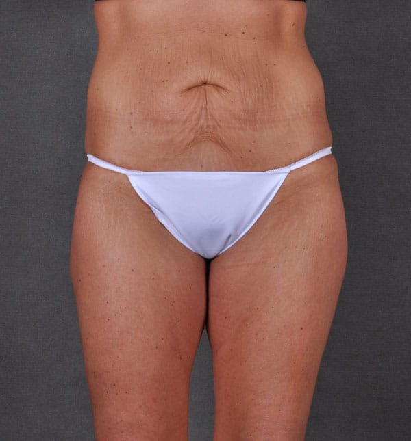 liposuction - patient 8682 - before 1 liposuction - patient 8682 - before 1
