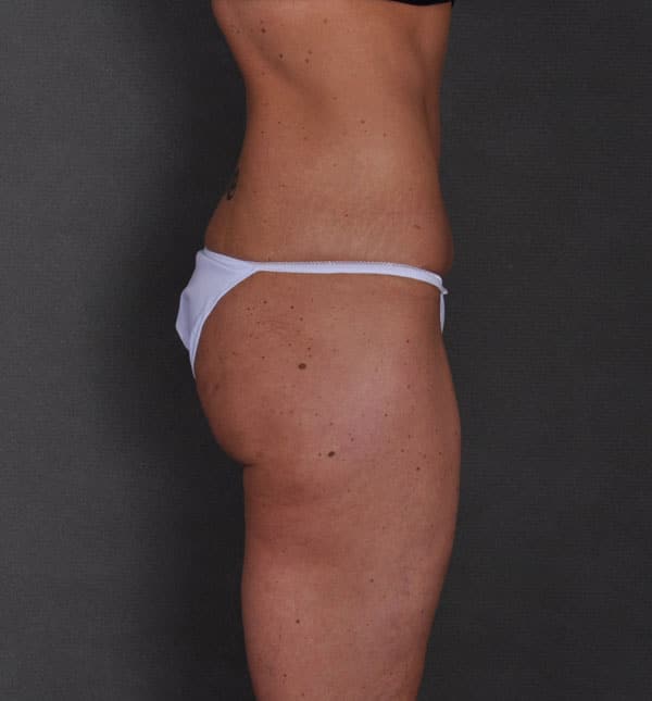 liposuction - patient 8682 - after 3 liposuction - patient 8682 - after 3