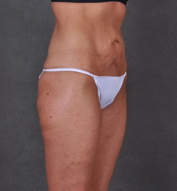 liposuction - patient 8682 - before 2 liposuction - patient 8682 - before 2
