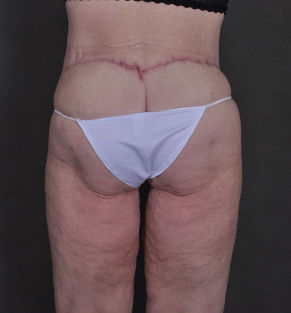 tummy tuck - patient Case 8652 - after 4 tummy tuck - patient Case 8652 - after 4