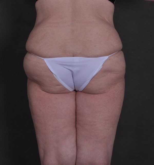 tummy tuck - patient Case 8652 - before 4 tummy tuck - patient Case 8652 - before 4