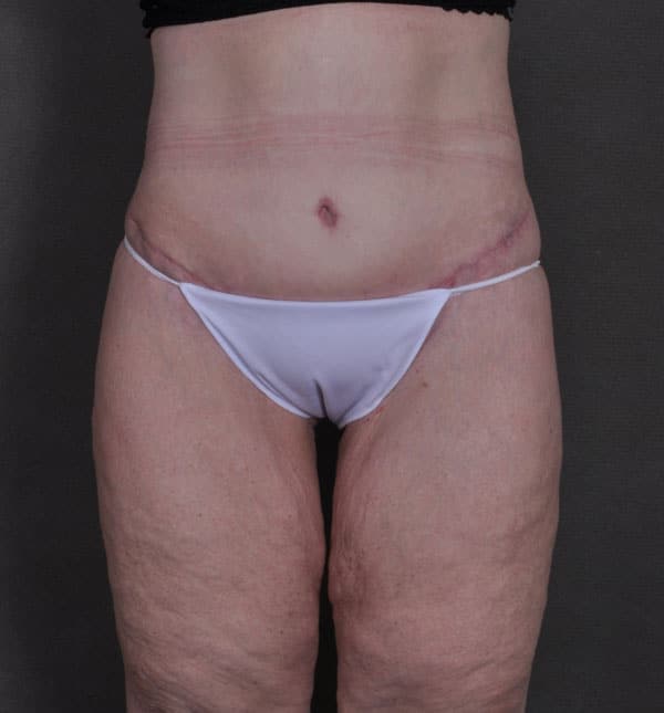 tummy tuck - patient Case 8652 - after 1 tummy tuck - patient Case 8652 - after 1
