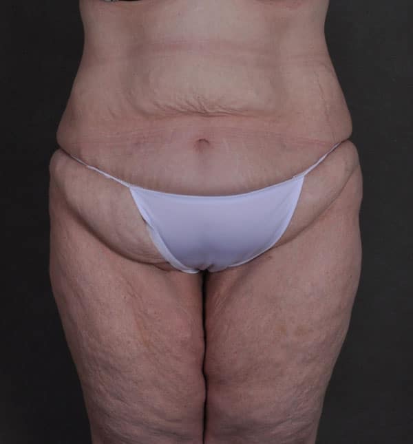 tummy tuck - patient Case 8652 - before 1 tummy tuck - patient Case 8652 - before 1