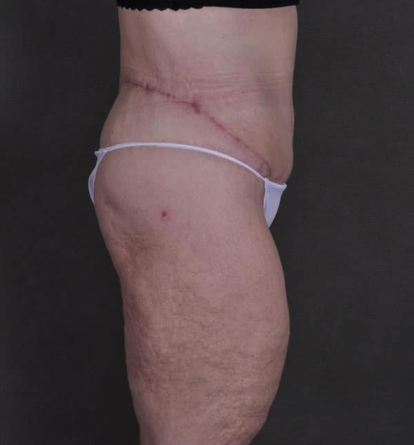 tummy tuck - patient Case 8652 - after 3 tummy tuck - patient Case 8652 - after 3