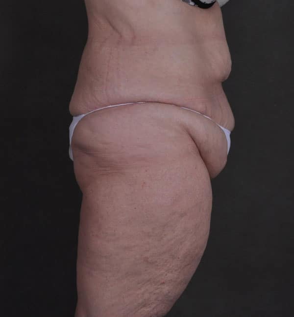 tummy tuck - patient Case 8652 - before 3 tummy tuck - patient Case 8652 - before 3
