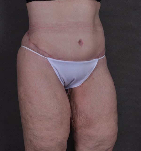 tummy tuck - patient Case 8652 - after 2 tummy tuck - patient Case 8652 - after 2