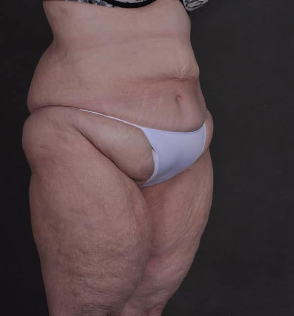 tummy tuck - patient Case 8652 - before 2 tummy tuck - patient Case 8652 - before 2