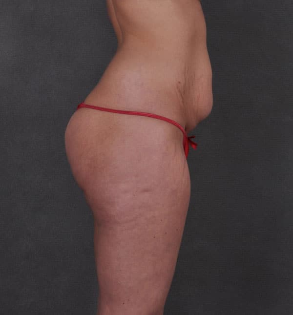 liposuction - patient 8700 - before 3 liposuction - patient 8700 - before 3