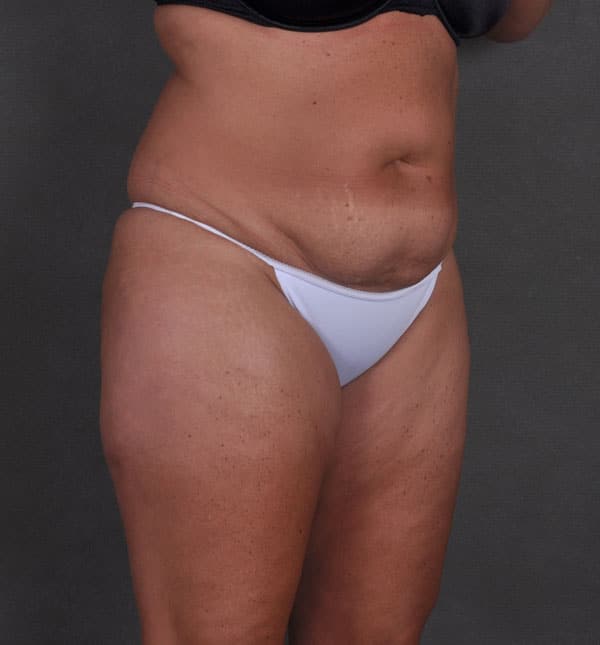 tummy tuck - patient 8708 - before 2 tummy tuck - patient 8708 - before 2