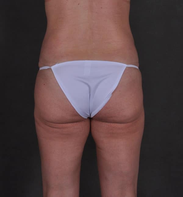 breast augmentation - patient 8719 - after 7 breast augmentation - patient 8719 - after 7
