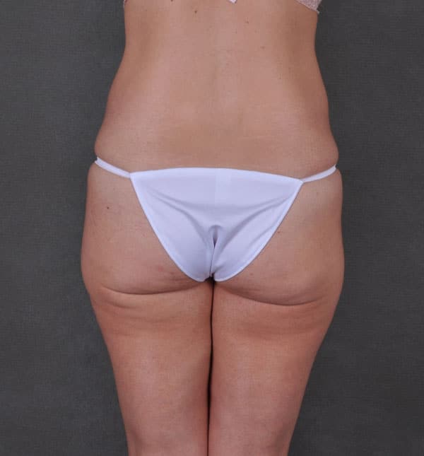 breast augmentation - patient 8719 - before 7 breast augmentation - patient 8719 - before 7