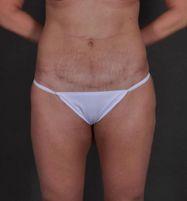 breast augmentation - patient 8719 - after 4 breast augmentation - patient 8719 - after 4