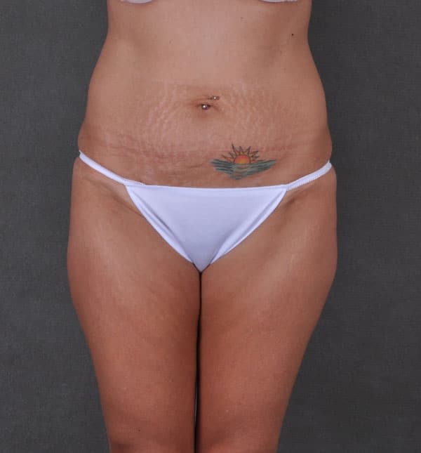 breast augmentation - patient 8719 - before 4 breast augmentation - patient 8719 - before 4
