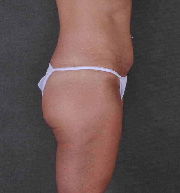 breast augmentation - patient 8719 - before 6 breast augmentation - patient 8719 - before 6