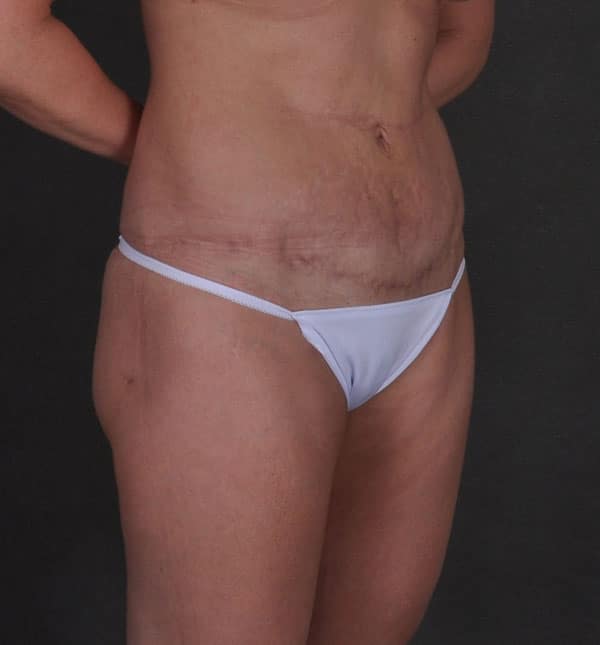 breast augmentation - patient 8719 - after 5 breast augmentation - patient 8719 - after 5