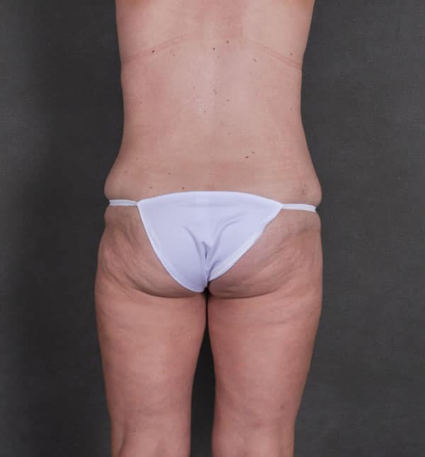 liposuction - patient 8755 - after 6 liposuction - patient 8755 - after 6