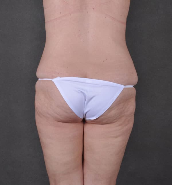 liposuction - patient 8755 - before 6 liposuction - patient 8755 - before 6
