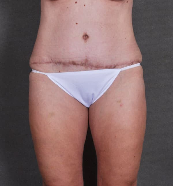 liposuction - patient 8755 - after 3 liposuction - patient 8755 - after 3