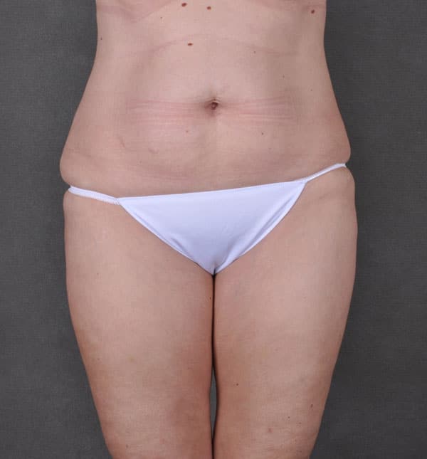 liposuction - patient 8755 - before 3 liposuction - patient 8755 - before 3