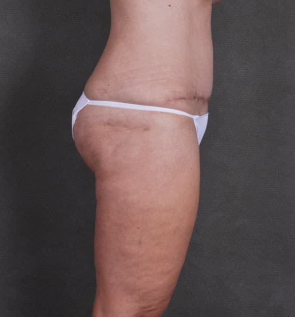 liposuction - patient 8755 - after 5 liposuction - patient 8755 - after 5