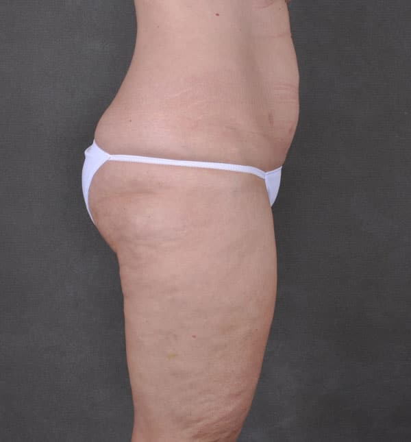 liposuction - patient 8755 - before 5 liposuction - patient 8755 - before 5
