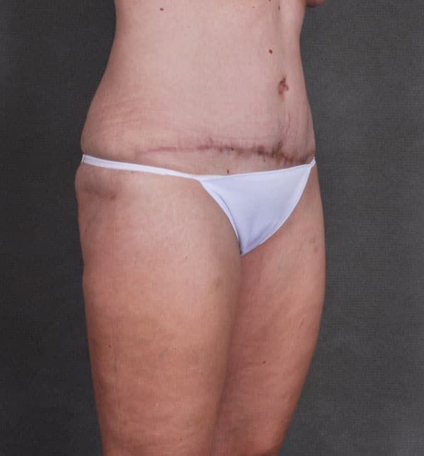 liposuction - patient 8755 - after 4 liposuction - patient 8755 - after 4