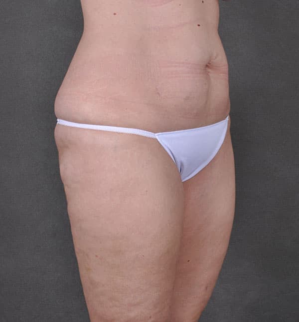 liposuction - patient 8755 - before 4 liposuction - patient 8755 - before 4