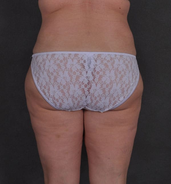 tummy tuck - patient 8786 - after 4 tummy tuck - patient 8786 - after 4